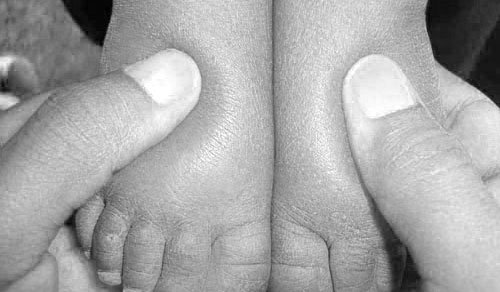 Отекают ноги у ребенка лечение thumbnail