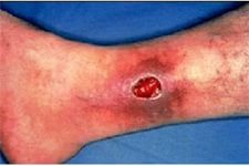 Кровоточащие язвы лечение на ногах